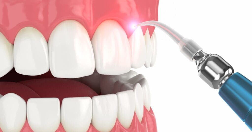 Laser Dentistry