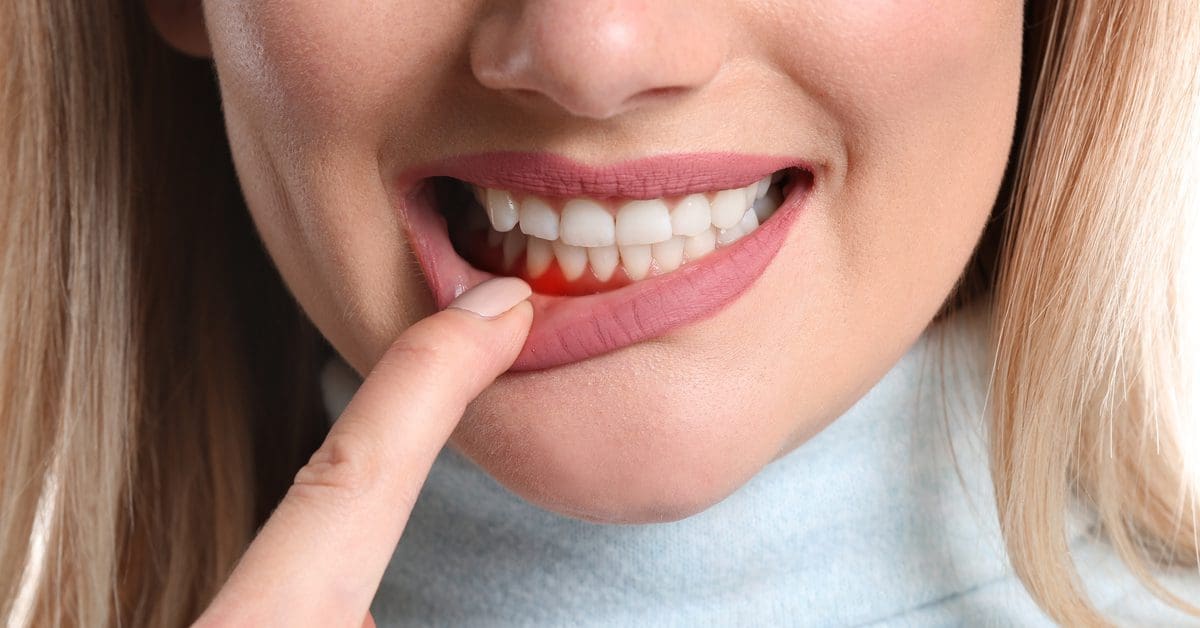 What is gum disease and how do you prevent it?