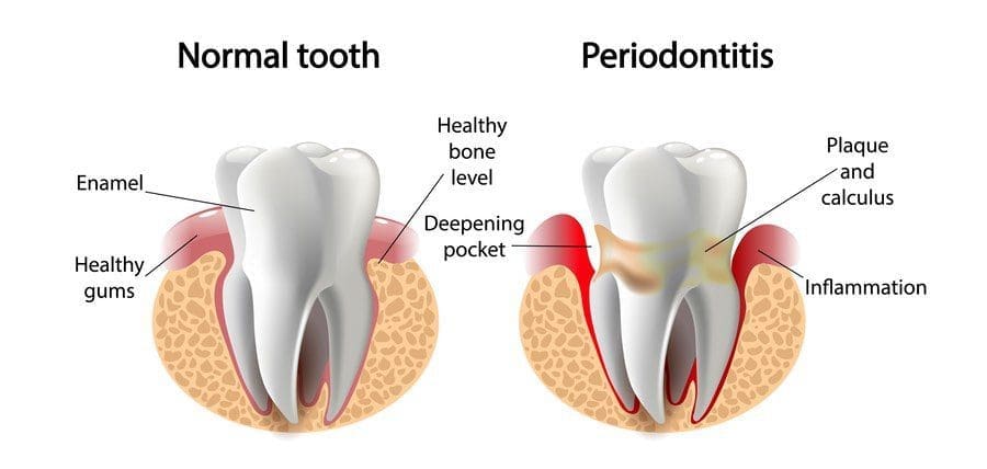 Prevention and Treatment of Periodontal Disease