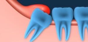 Do You Have an Infected Wisdom Tooth?