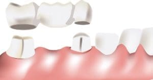 Dental Bridges Replace Missing Teeth