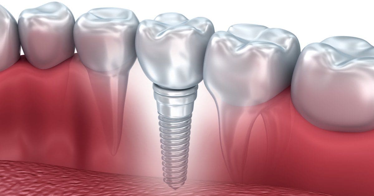 Specialist In Dental Implants West Orange, Essex County
