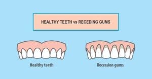 5 Main Causes of Receding Gums