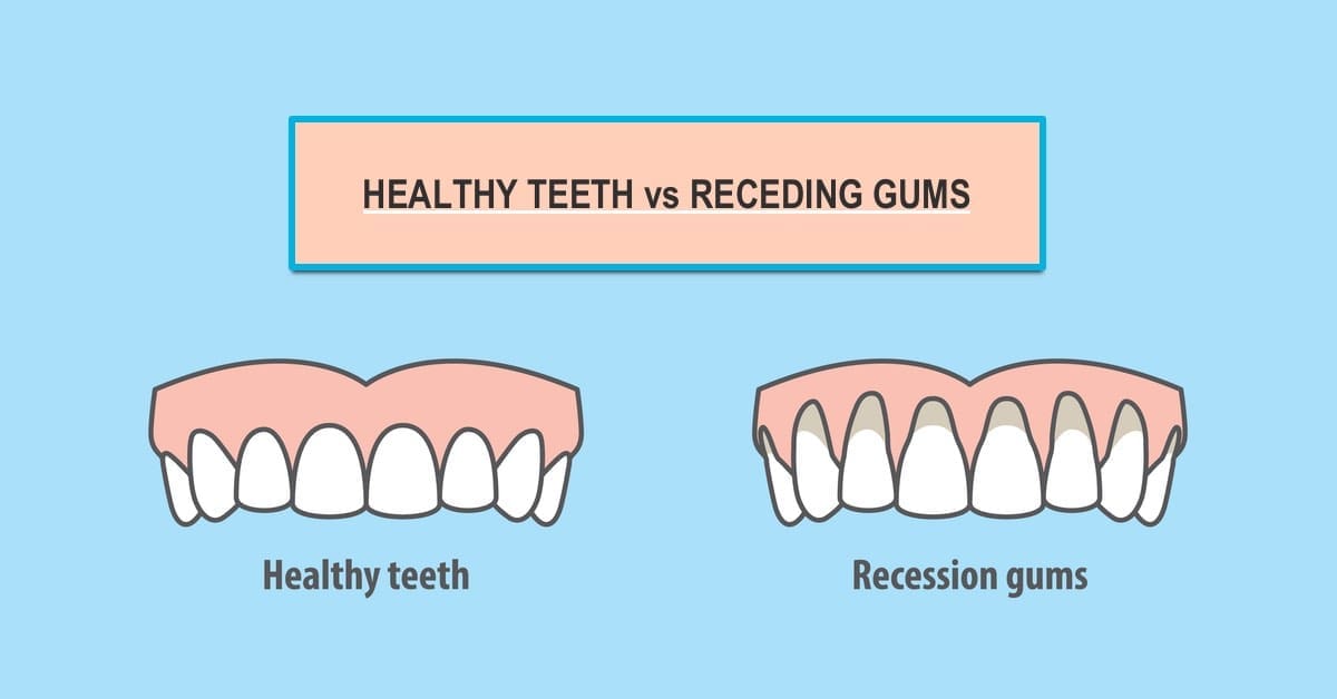 5 Main Causes of Receding Gums