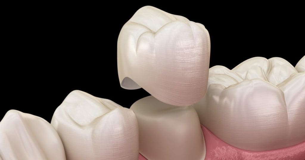 Difference Between Dental Crowns &Amp; Veneers, Pros, Cons Crowns &Amp; Veneers Crowns &Amp; Veneers