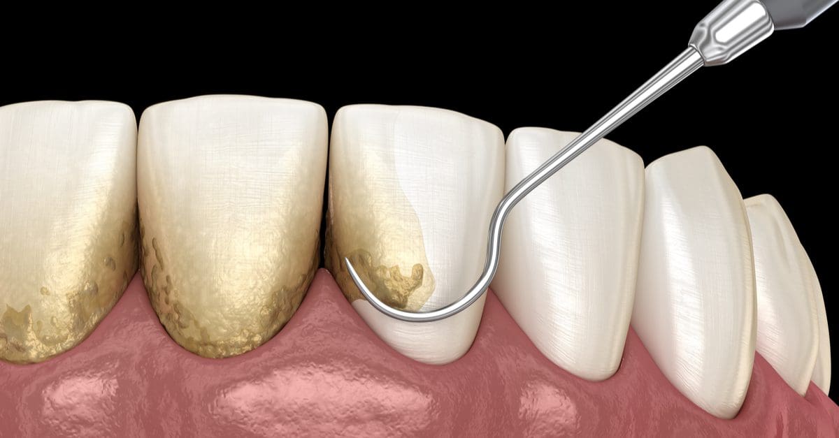 A Complete Guide to Dental Scaling and Root Planing
