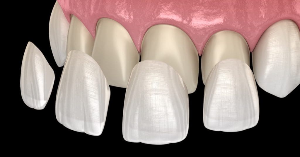 Difference Between Dental Crowns &Amp; Veneers, Pros, Cons