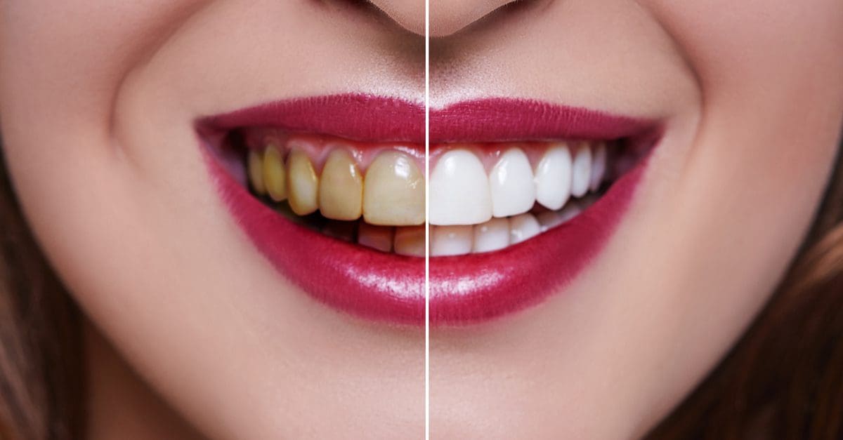 Cosmetic Dentistry, Veneers and the Process
