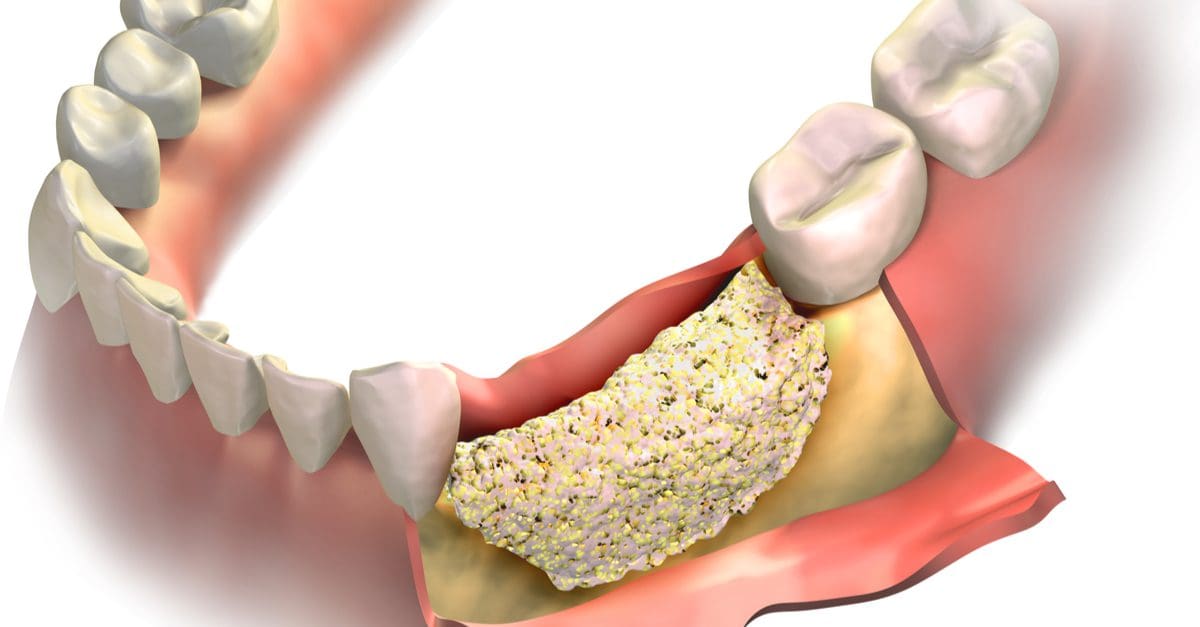 Bone Graft Tooth Extraction