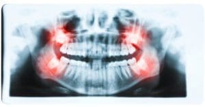 Impacted Tooth? Symptoms, Removal, Treatment