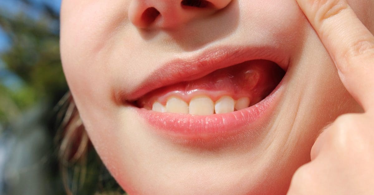 What is a Parulis? Dental Fistula Causes, Treatment