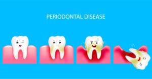 What Causes Gum Disease?