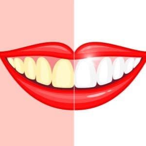 Professional Teeth Whitening Vs At Home Diy