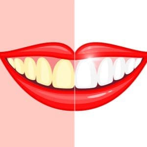 Professional Teeth Whitening Vs At Home Diy Teeth Whitening Vs At Home Professional Teeth Whitening Vs At Home Diy