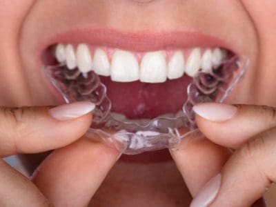 Clearcorrect Invisible Aligners