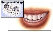 Dental Bridge Step 3