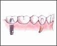Dental Implant For Missing Tooth