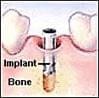 Dental Implant Step 1