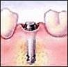 Dental Implant Step 2