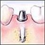 Dental Implant Step 3