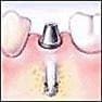 Dental Implant Step 3