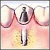 Dental Implant Step 4