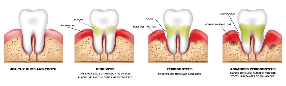 Periodontitis Inflammation Of Gums