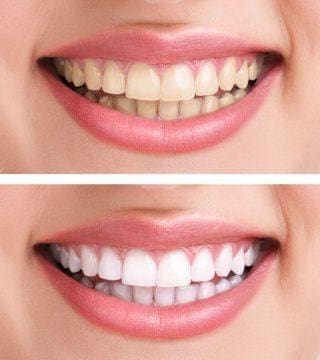 Teeth Whitening Teeth Whitening Services Teeth Whitening