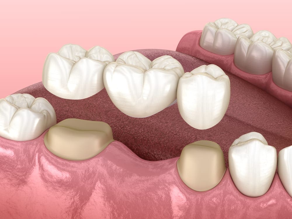 Dental Bridge