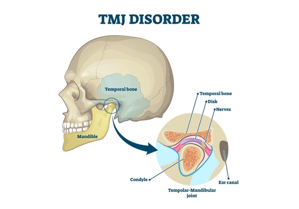Tmj Therapy