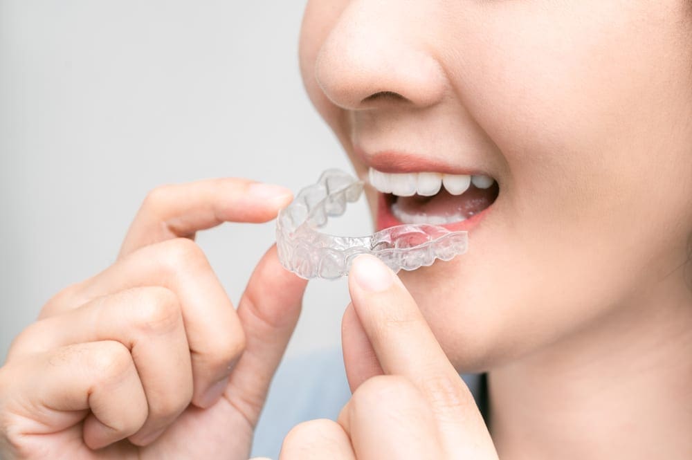 Invisalign Invisalign Invisalign