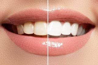 Teeth Whitening Kits At Suburban Essex Dental