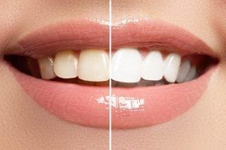 Teeth Whitening Teeth Whitening Services Teeth Whitening Kits At Suburban Essex Dental