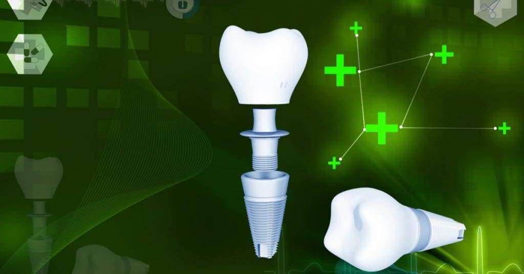 Best Options For Replacing Missing Teeth, Dental Implants, West Orange Nj
