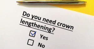Crown Lengthening: Reasons, Process, Benefits
