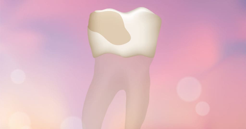 Tooth Erosion: Signs, Severity, Treatment &Amp; Prevention
