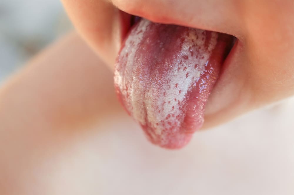 Oral Thrush: Symptoms, Causes and Treatment